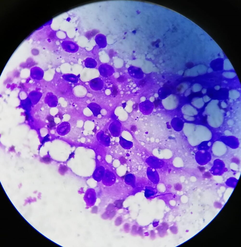 Aggregata Caso Clínico - Anemia severa en un gato FeLV + 12 lipidosis