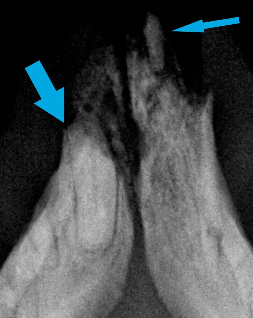 incisivos mandibulares